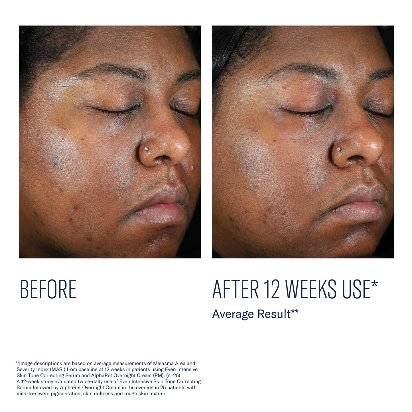 Even Intensive Skin Tone Correcting Serum