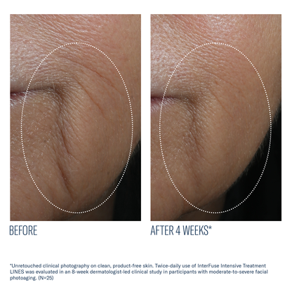 Interfuse Intensive Treatment LINES